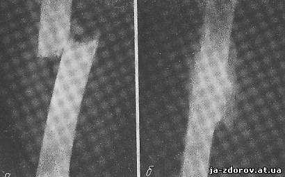 Рентгенограмма перелома бедра