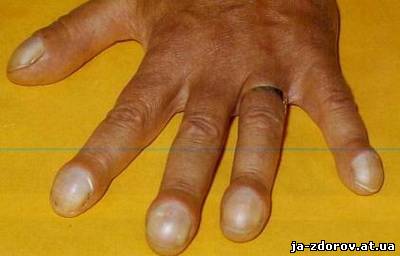 Утолщение ногтевых фаланг пальцев