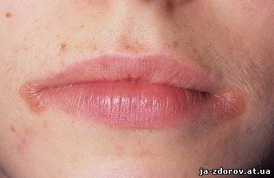 трещины и изъязвления в углах рта