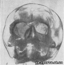рентгенограмма черепа в передней проекции