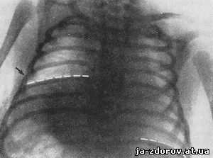 Диафрагмальная грыжа новорожденных рентген