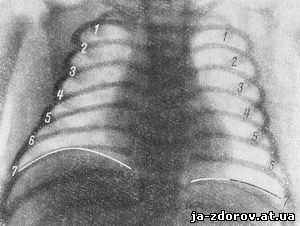 Диафрагмальная грыжа новорожденных рентген