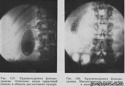 Показывает ли флюорография рак желудка